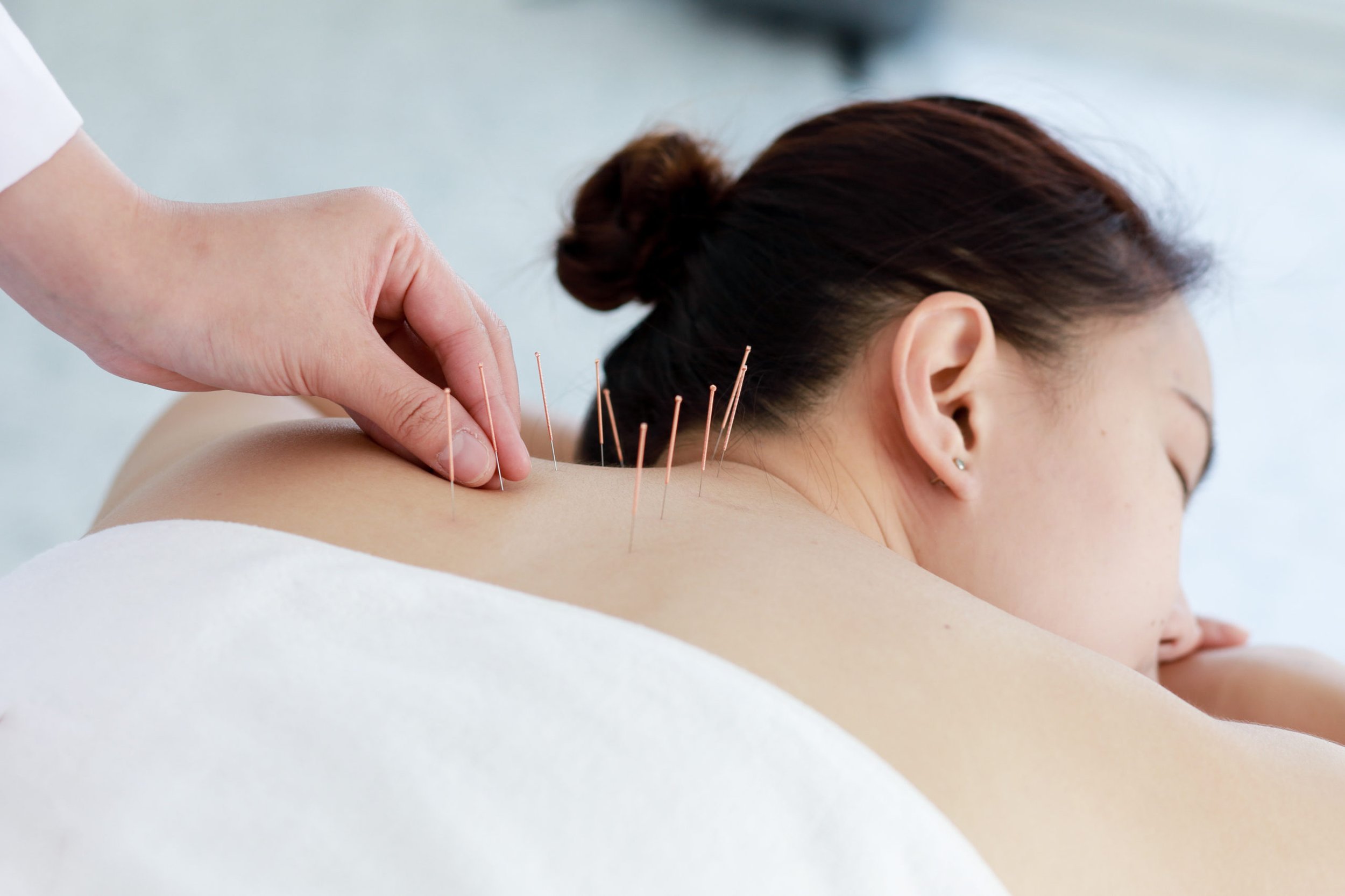 Acupuncture: Merging Ancient Wisdom with Modern Well-being