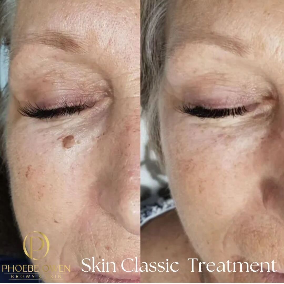 I've been realizing I haven't been giving my Skin Classic Treatment the spotlight it deserves. It works incredibly well for those pesky minor skin irregularities that many of my clients aren't sure how to tackle. 

🔍 Targeted Treatment: Skin Classic