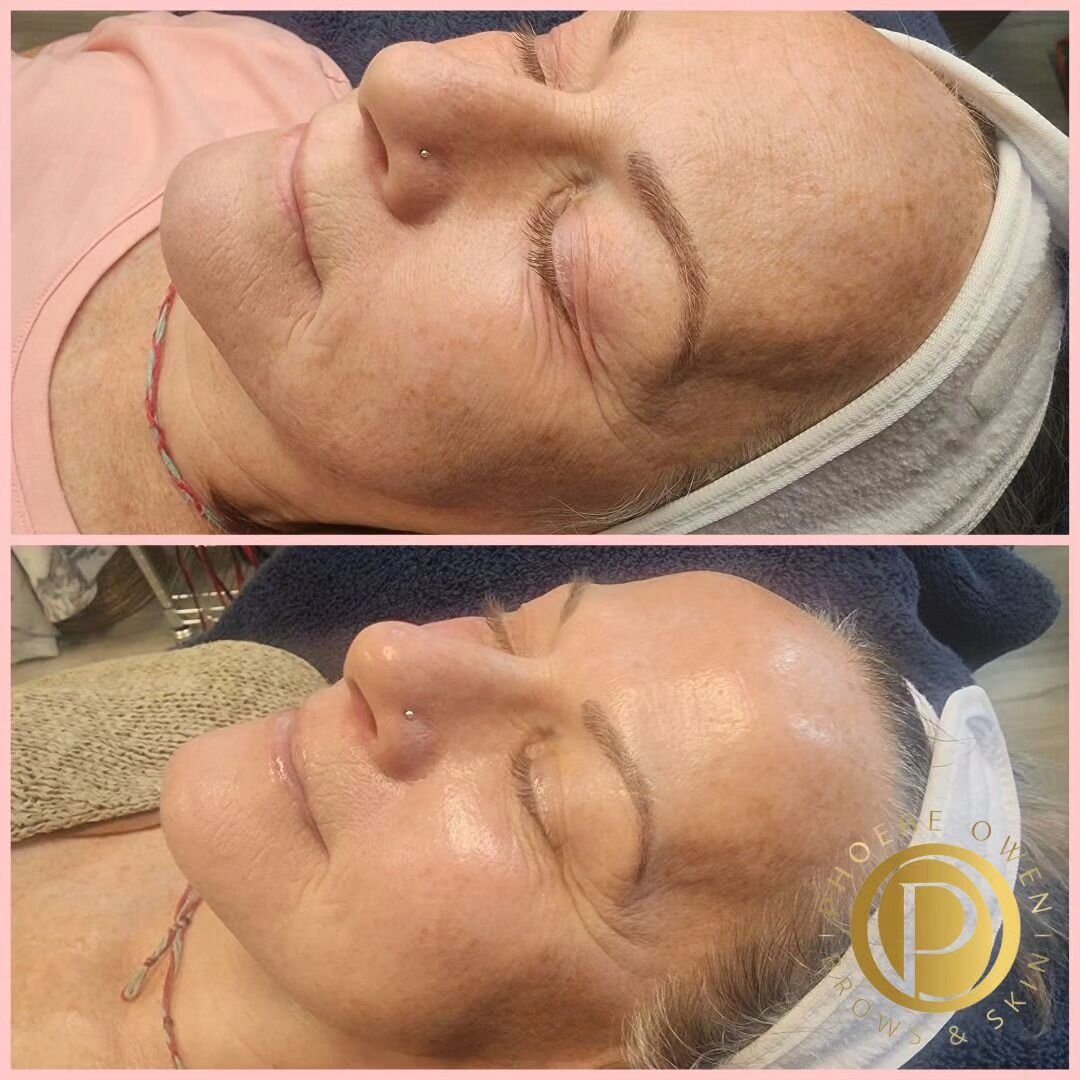 Exciting update on my clients' skincare journey! The magic isn't just in her Biorepeel🧪 Chemical Peel Treatments but also in the perfect blend of monthly in-office sessions and her dedicated homecare routine (which was very simplistic!) iS Clinical 