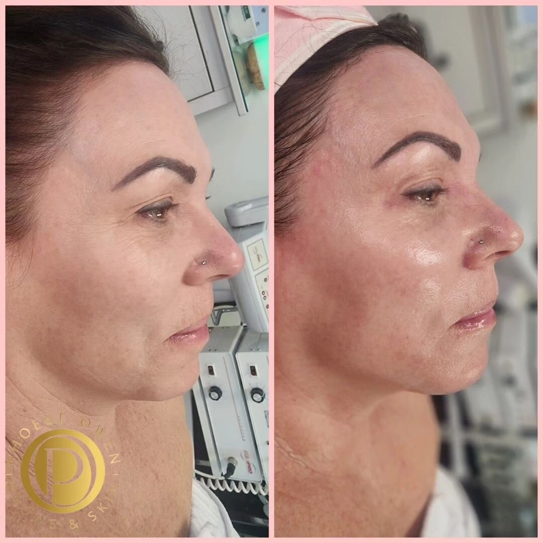 The DMK Enzyme Therapy Process 

✨ Step 1: Cleansing the skin with the perfect cleanser tailored to your unique skin's needs. 🫧

✨ Step 2: Exfoliation + Prep We'll prep your skin for the Enzyme Masque with professional-grade exfoliation, targeting y