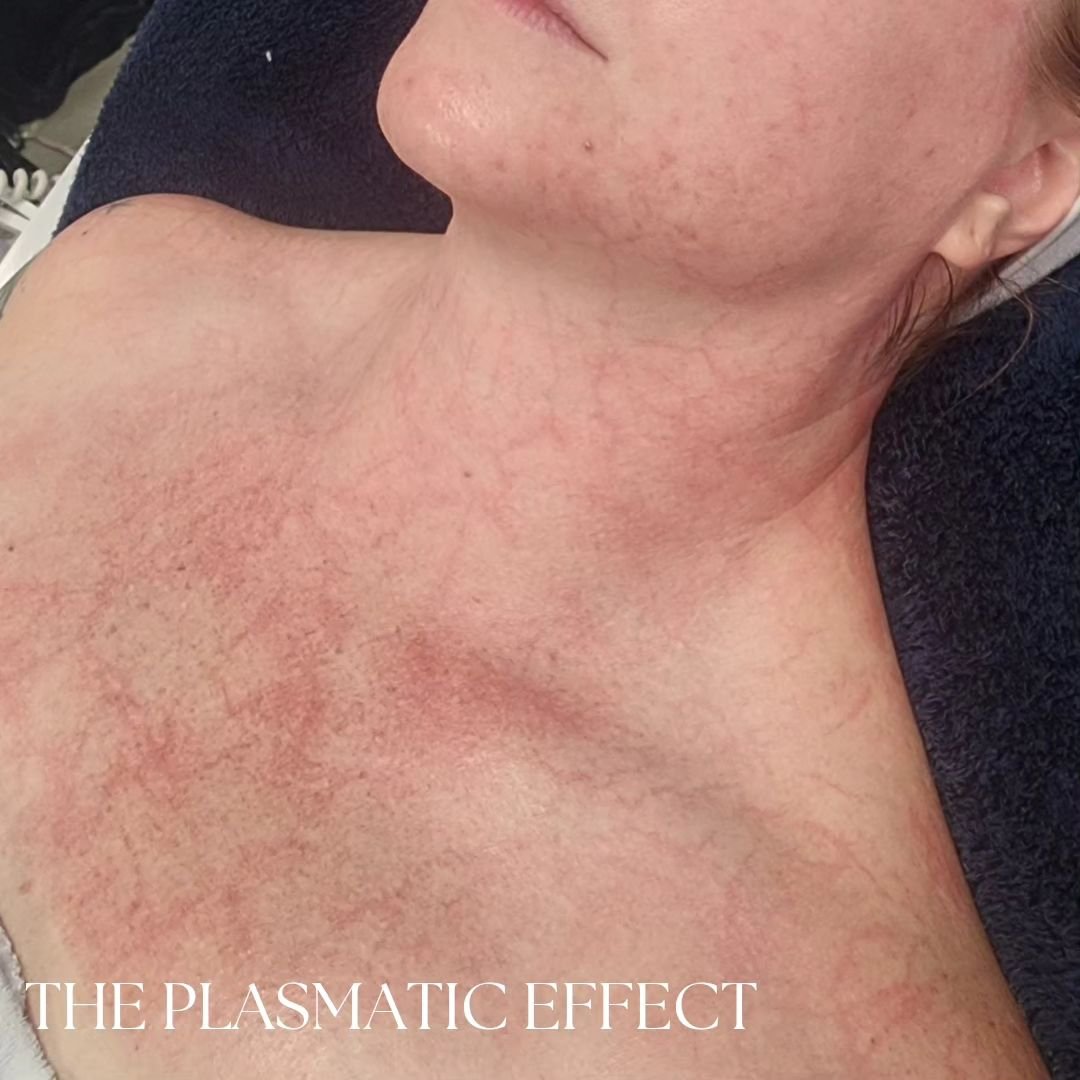 What is the Plasmatic Effect? 

DMK Enzyme Treatment promotes a new rush of fresh oxygenated blood from within the skin due to the dilated capillaries. True Oxygen Therapy 🫧

The capillaries stand out like a road map-proving the effects of the enzym