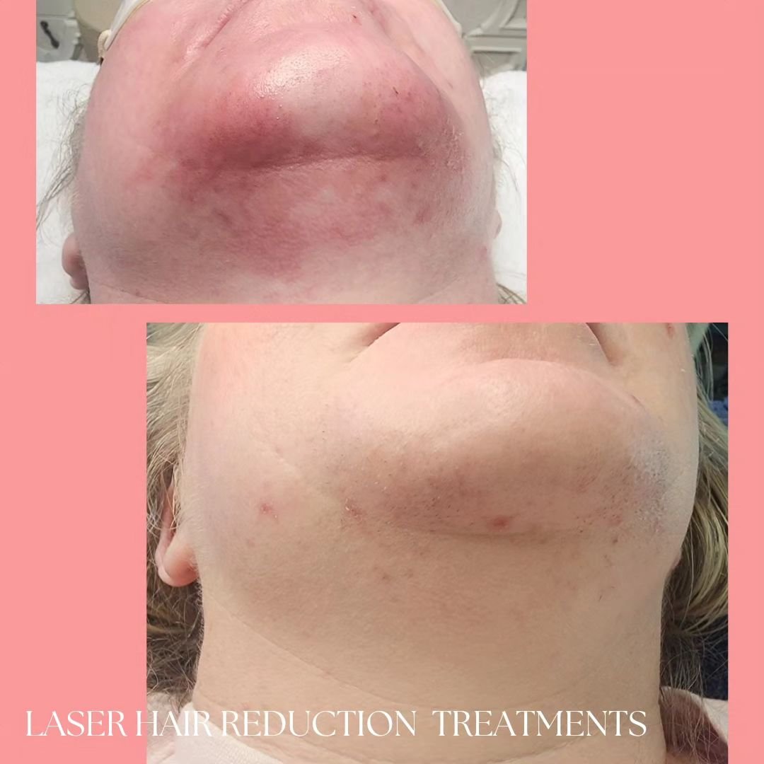 Laser Hair Removal/Reduction Of Unwanted Hairs. 

Her after photo looks a little red. However, this is a positive endpoint for her skin type, and the redness will subside in a few hours. A bit of redness following treatment indicates her hairs were t