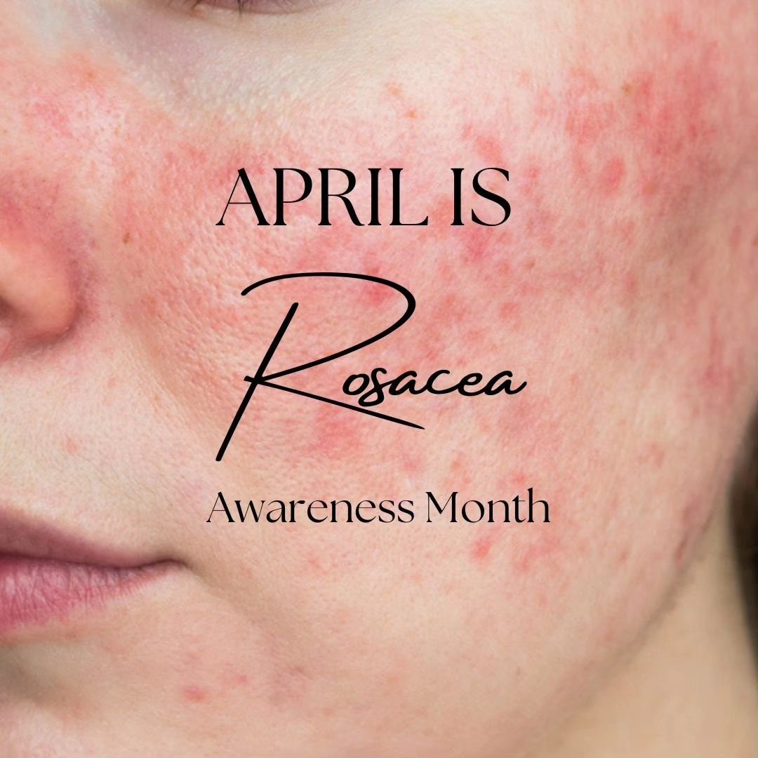 🌹 April is Rosacea Awareness Month! 🌹

This month, we're shining a light on rosacea, a chronic skin condition that affects millions worldwide. Though it's widely prevalent, many remain unaware of its triggers and treatment options.

Swipe through o