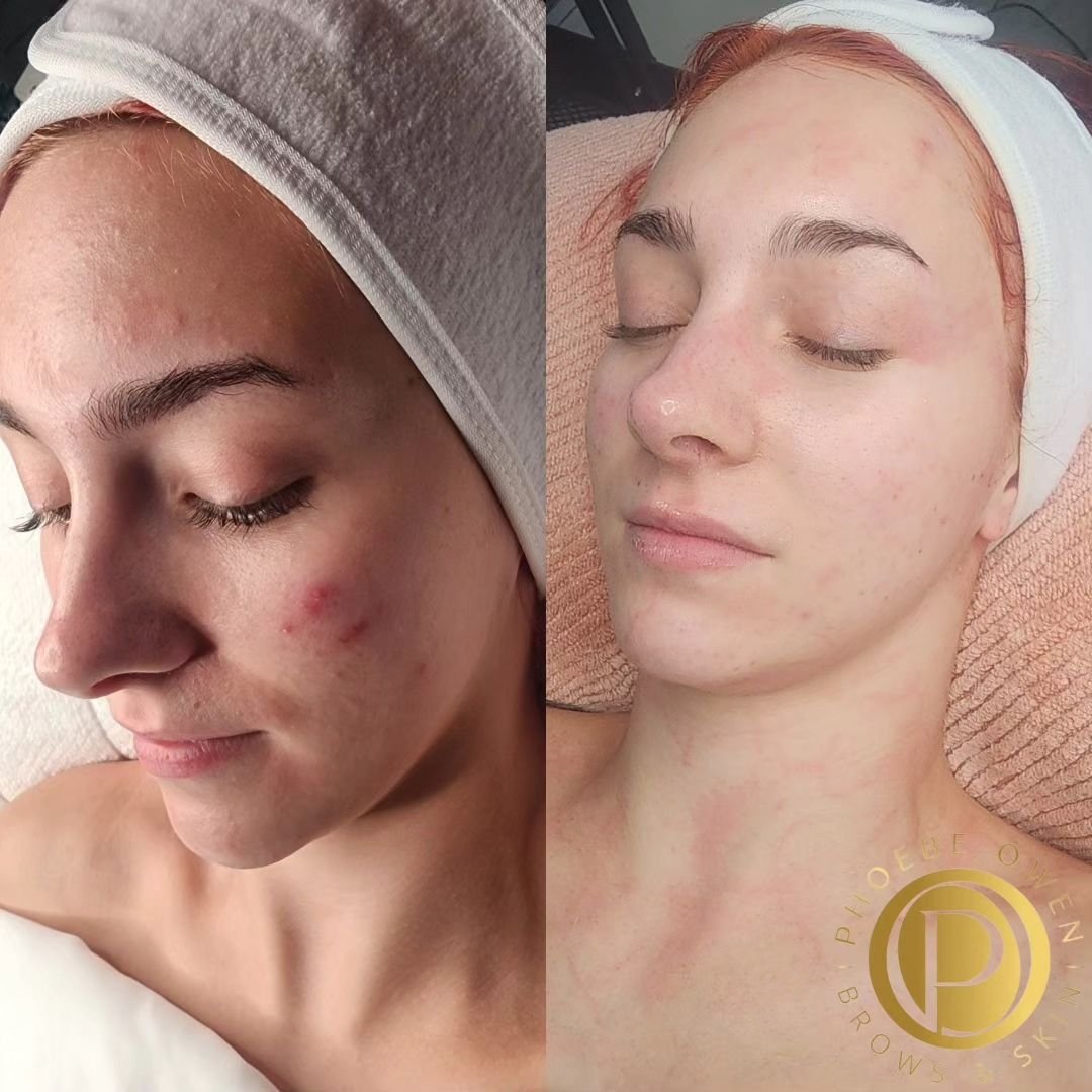My Beautiful Clients Skin Progression ✨️

We started her off with the Acne Therapy Facial, this includes the Skin Classic Treatment which uses high frequency to force a purge of her skin while healing and turning over her skin cells in specific areas