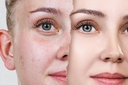Erase acne scars and reveal smoother skin with advanced Fotona laser treatment—non-invasive, precise, and effective for lasting results.