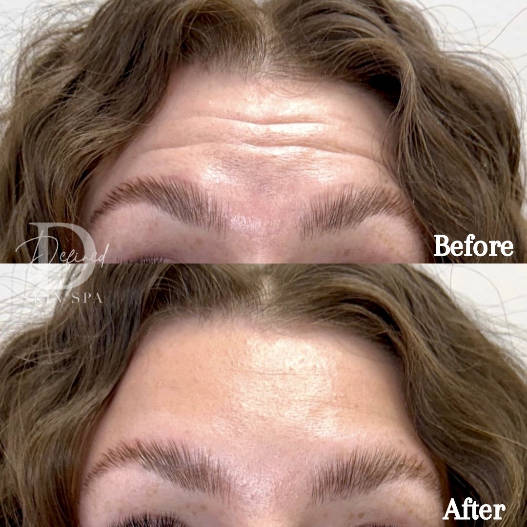 28 units of Botox in Forehead & Glabella