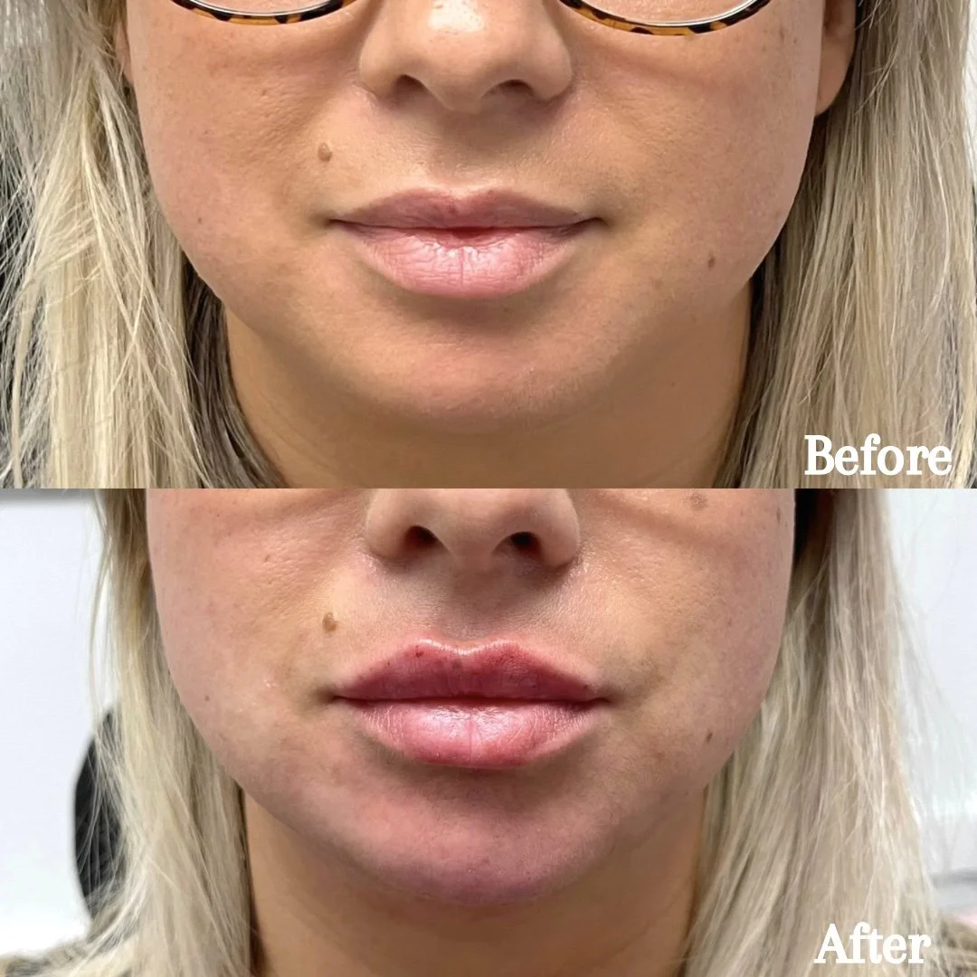 Revanesse Versa & Lips (top lip & chin filler)