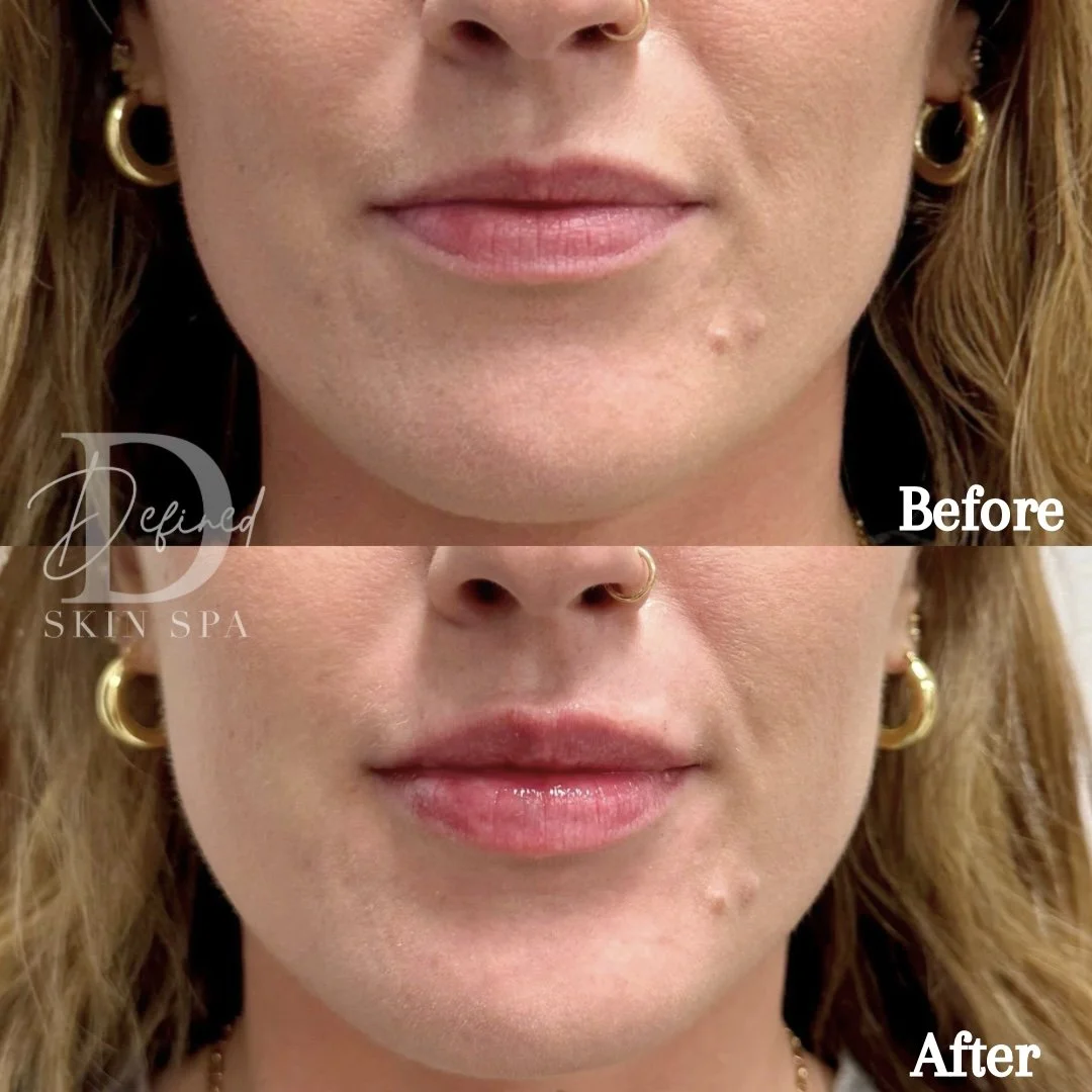 0.5 syringe of Revanesse Versa+ and Botox Lip Flip