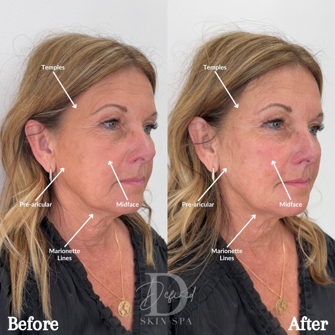 Full Facial Balancing with Bellafill

(1 Full Kit Used)