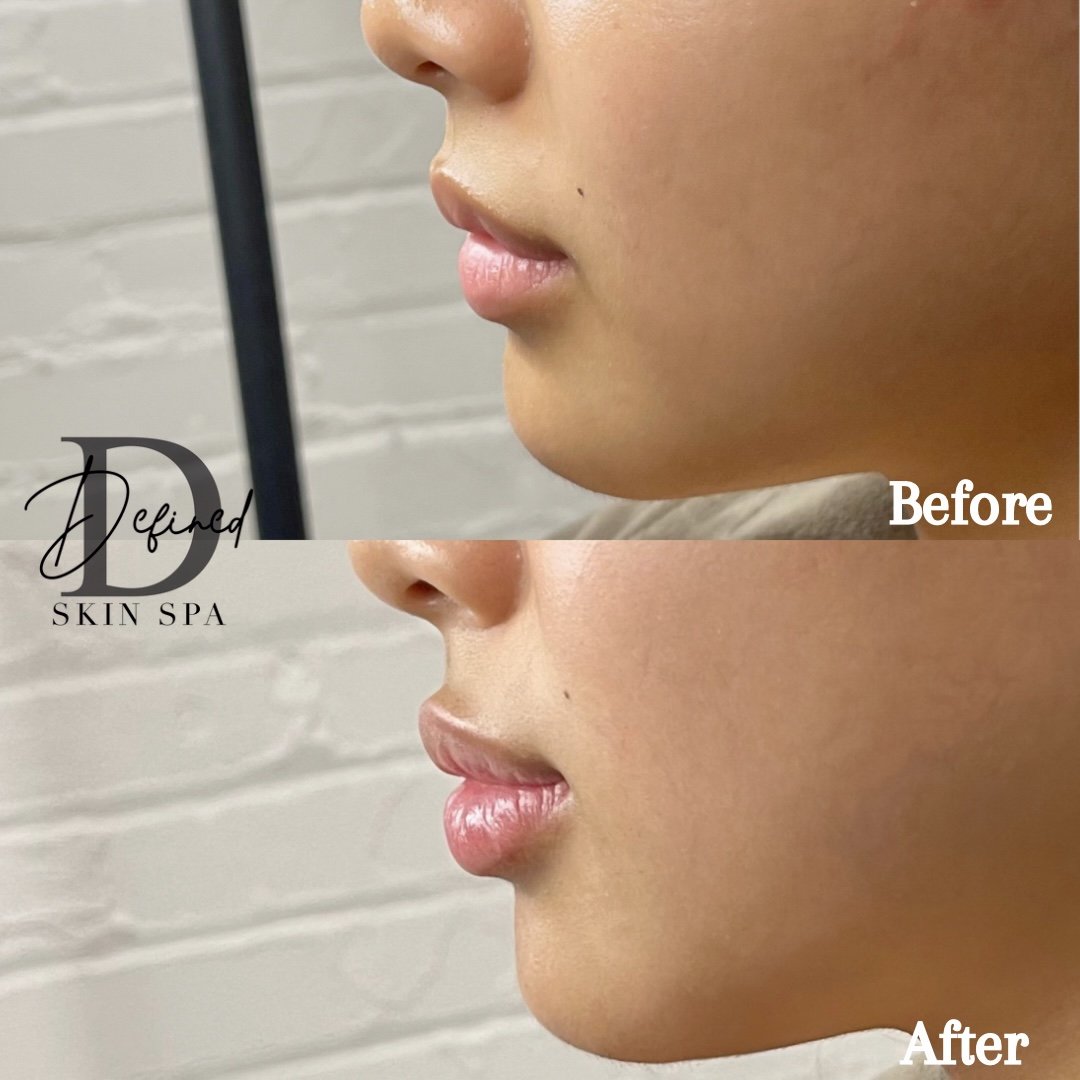 Client's lips, touched up with 1 syringe of Restylane Kysse