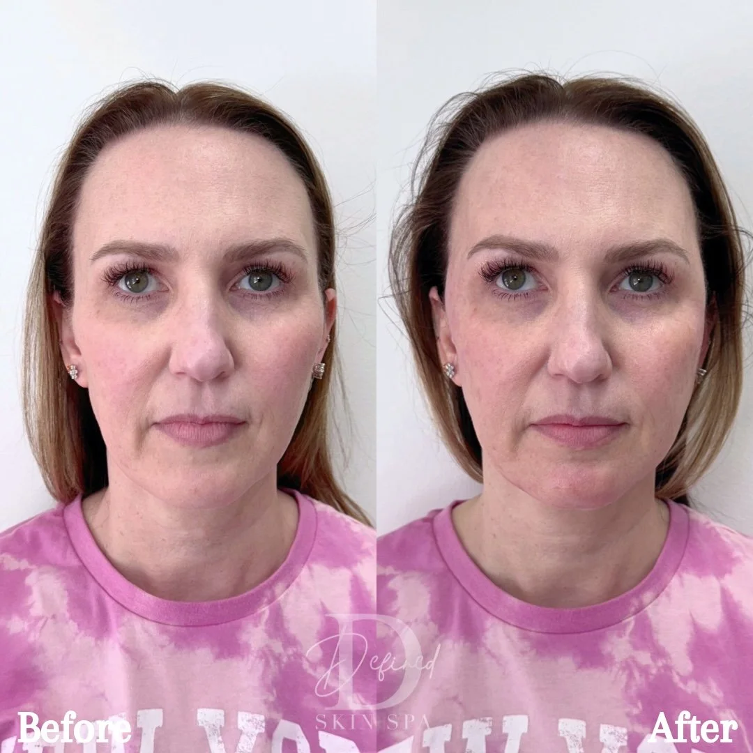 Full Facial Balancing with Bellafill

(1 Full Kit Used)