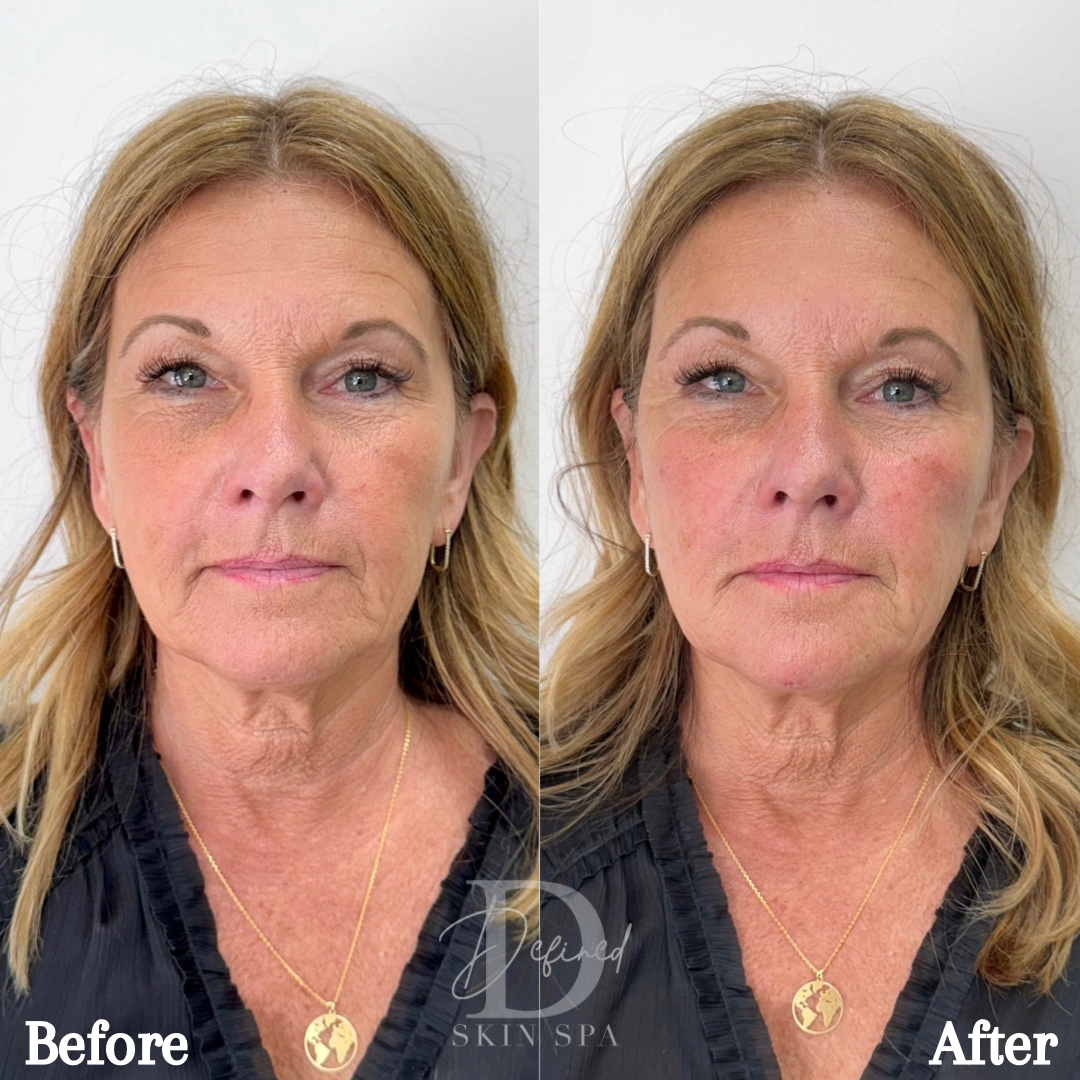Full Facial Balancing with Bellafill

(1 Full Kit Used)
