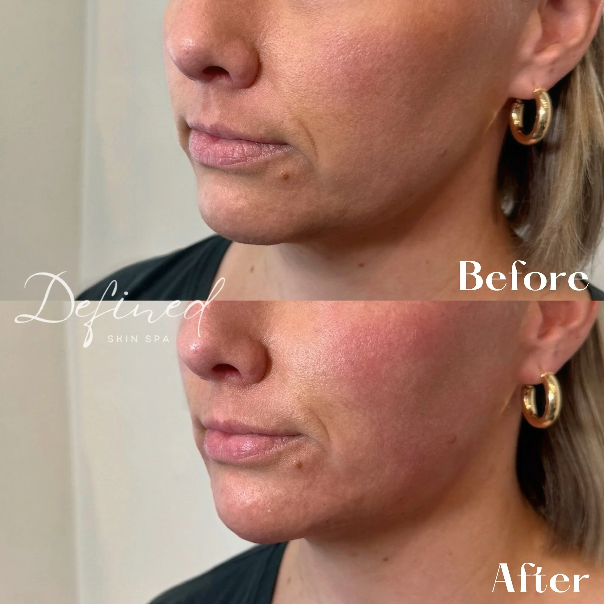 Full-Facial Balancing

(1 kit of Bellafill used)