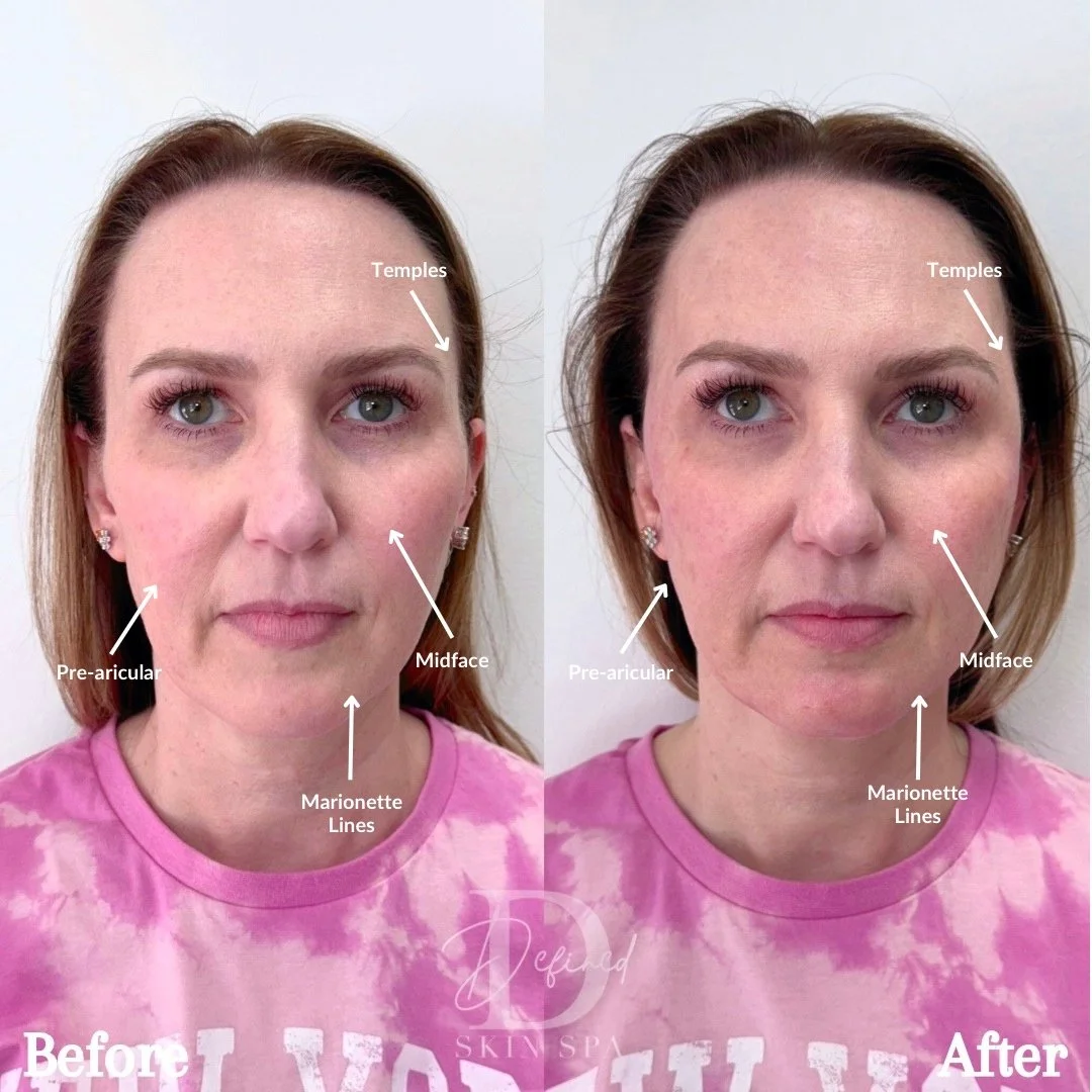 Full Facial Balancing with Bellafill

(1 Full Kit Used)