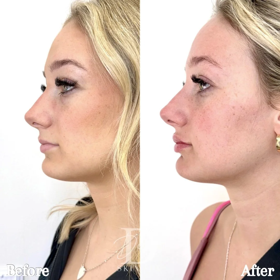 1 syringe of Revanesse Lips + and 8 units for Botox Lip Flip