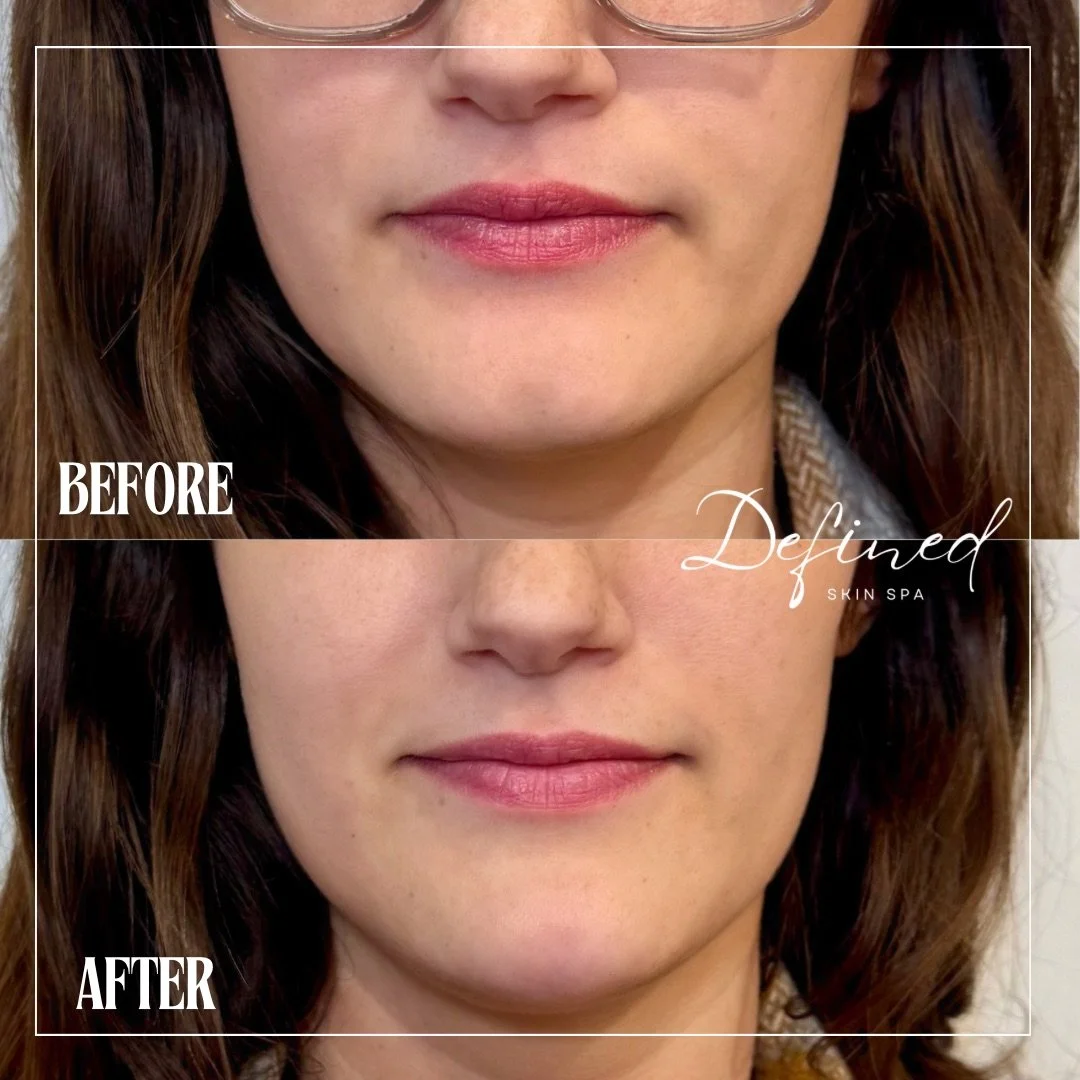 Chin Filler

(1 syringe of Restylane Lyft used)