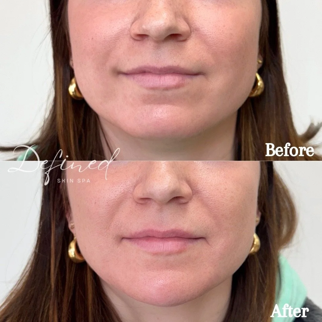 Chin Filler

(1 syringe of Restylane Lyft used)
