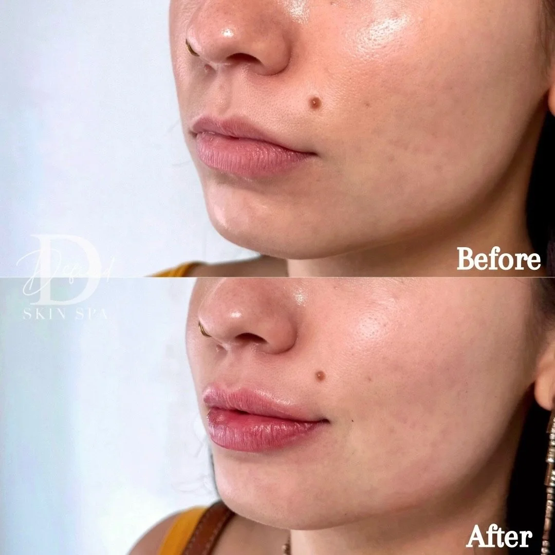 1 syringe of Lip Filler