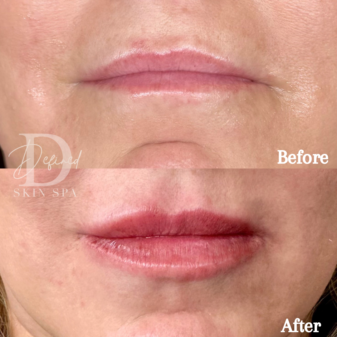 1 syringe of Revanesse Lips +