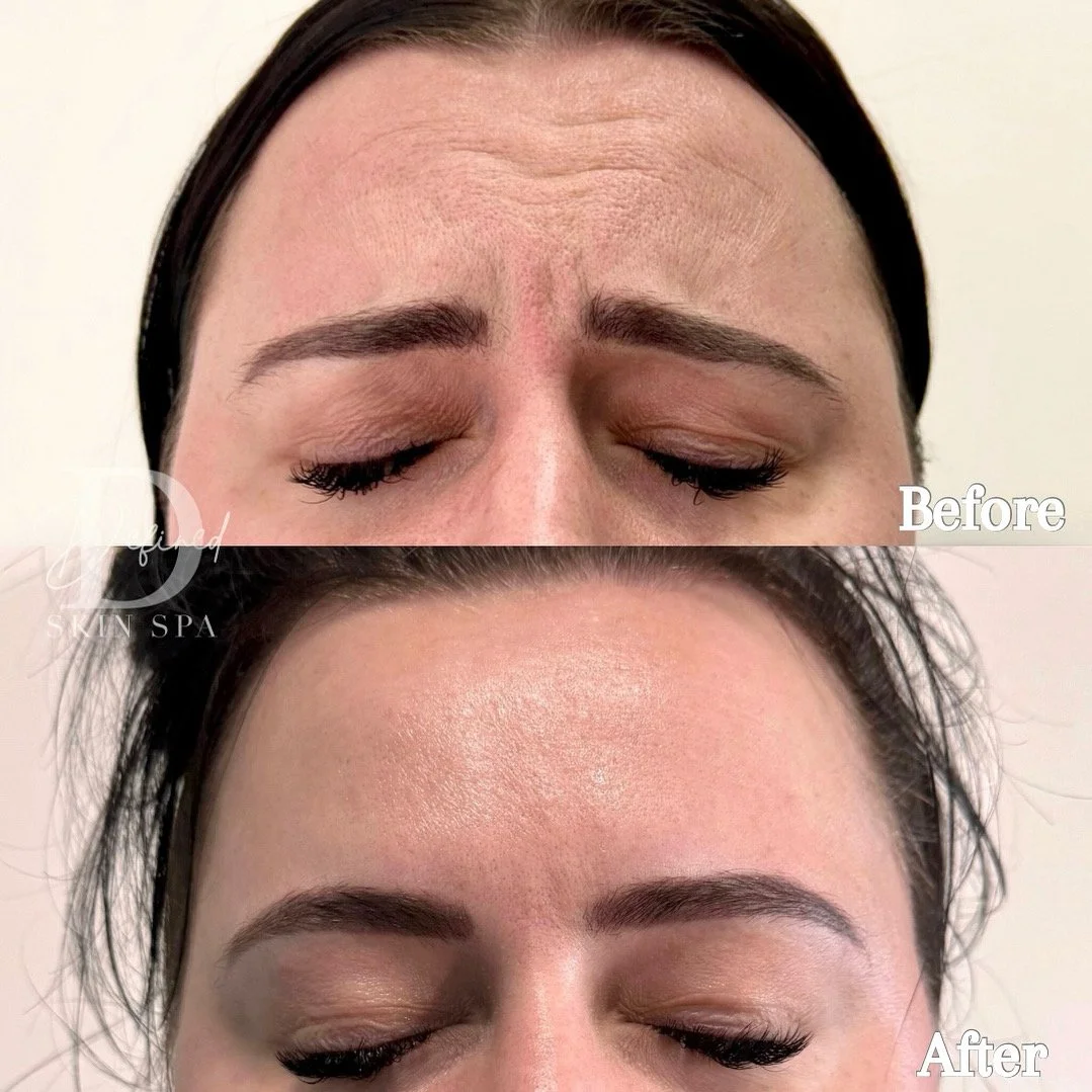 55 units of Jeuveau (Forehead, Glabella, Brow Lift, Crow's Feet) 