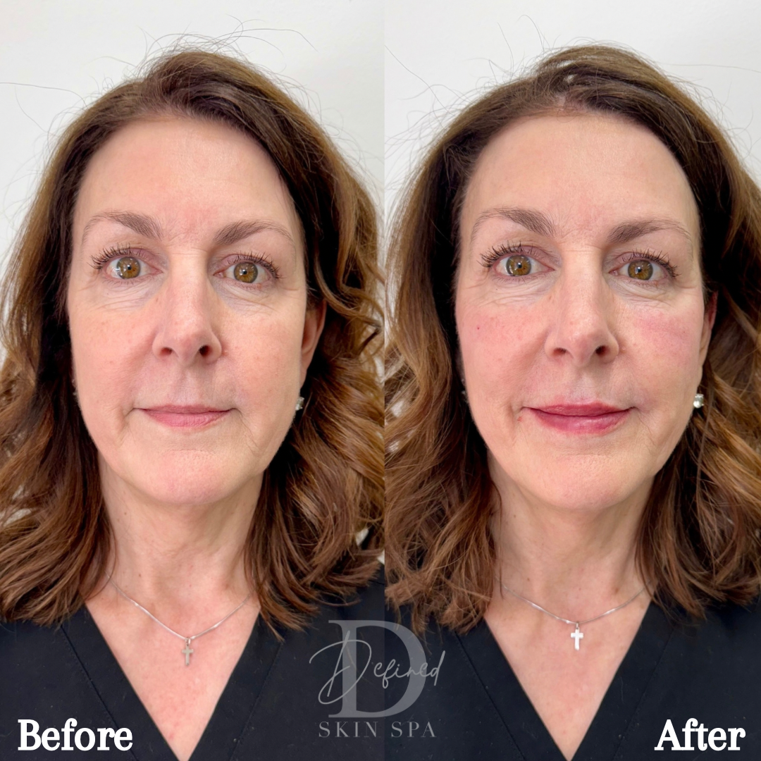 Full Facial Balancing