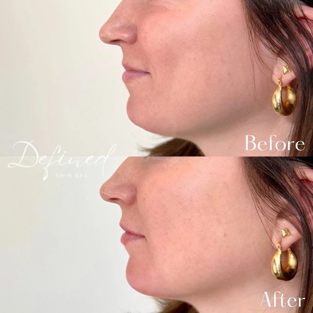 Chin Filler

(1 syringe of Restylane Lyft used)