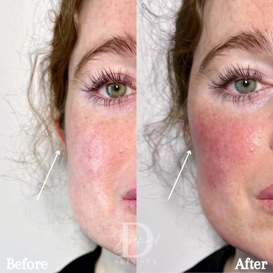 Acne scar and volume loss treatment

(2 syringes of Bellafill used)