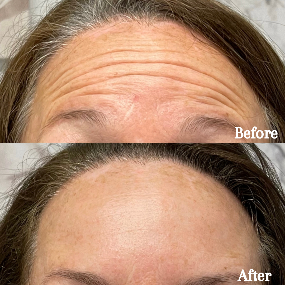 First Time Tox Client - 64 units of Jeuveau (Forehead, Glabella, Crow's Feet)
