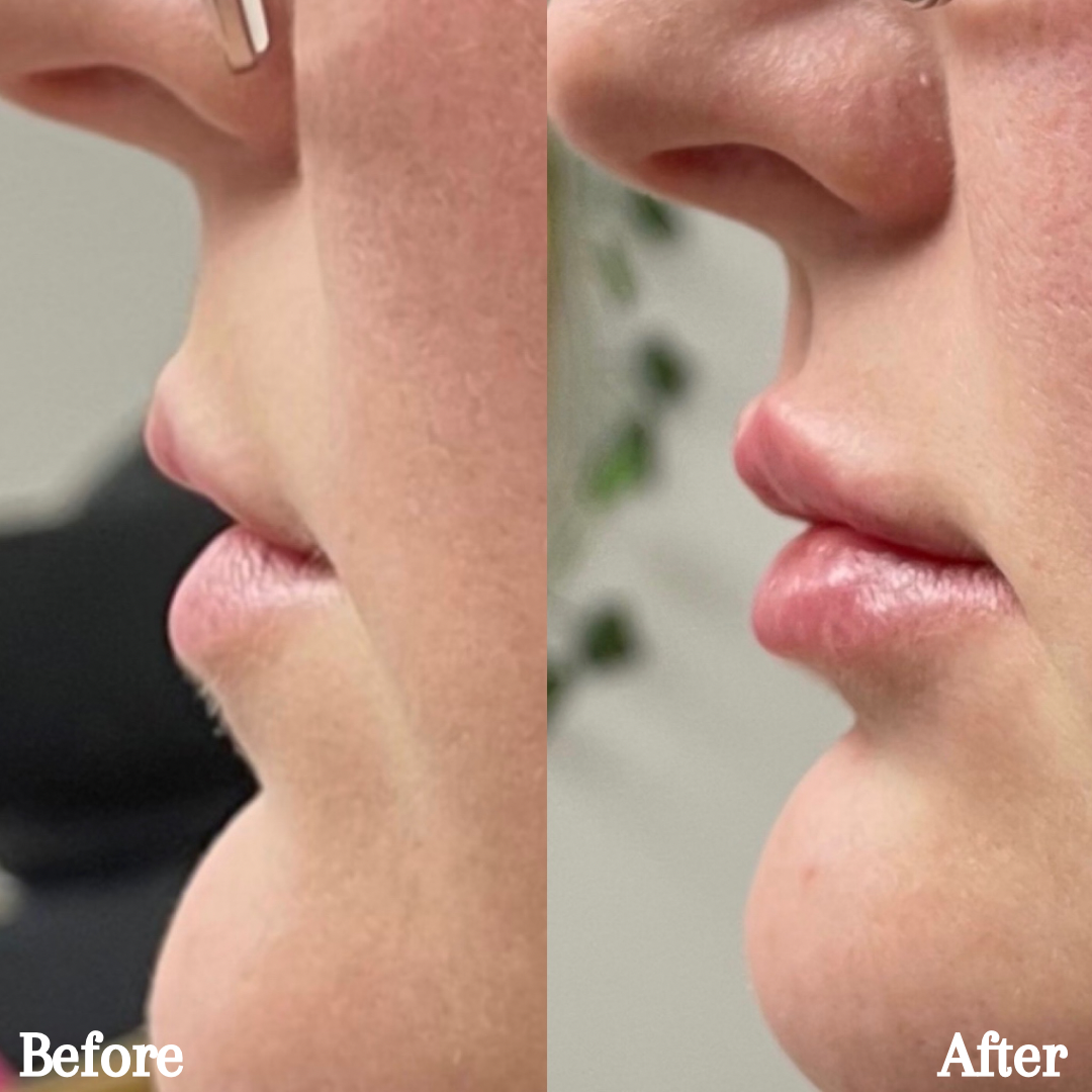 1 syringe of Revanesse Lips +