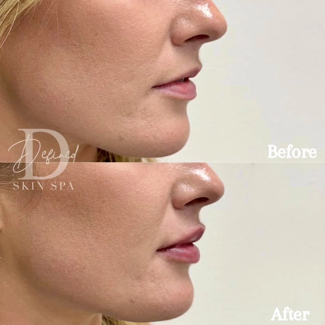 0.5 syringe of Revanesse Versa+ and Botox Lip Flip