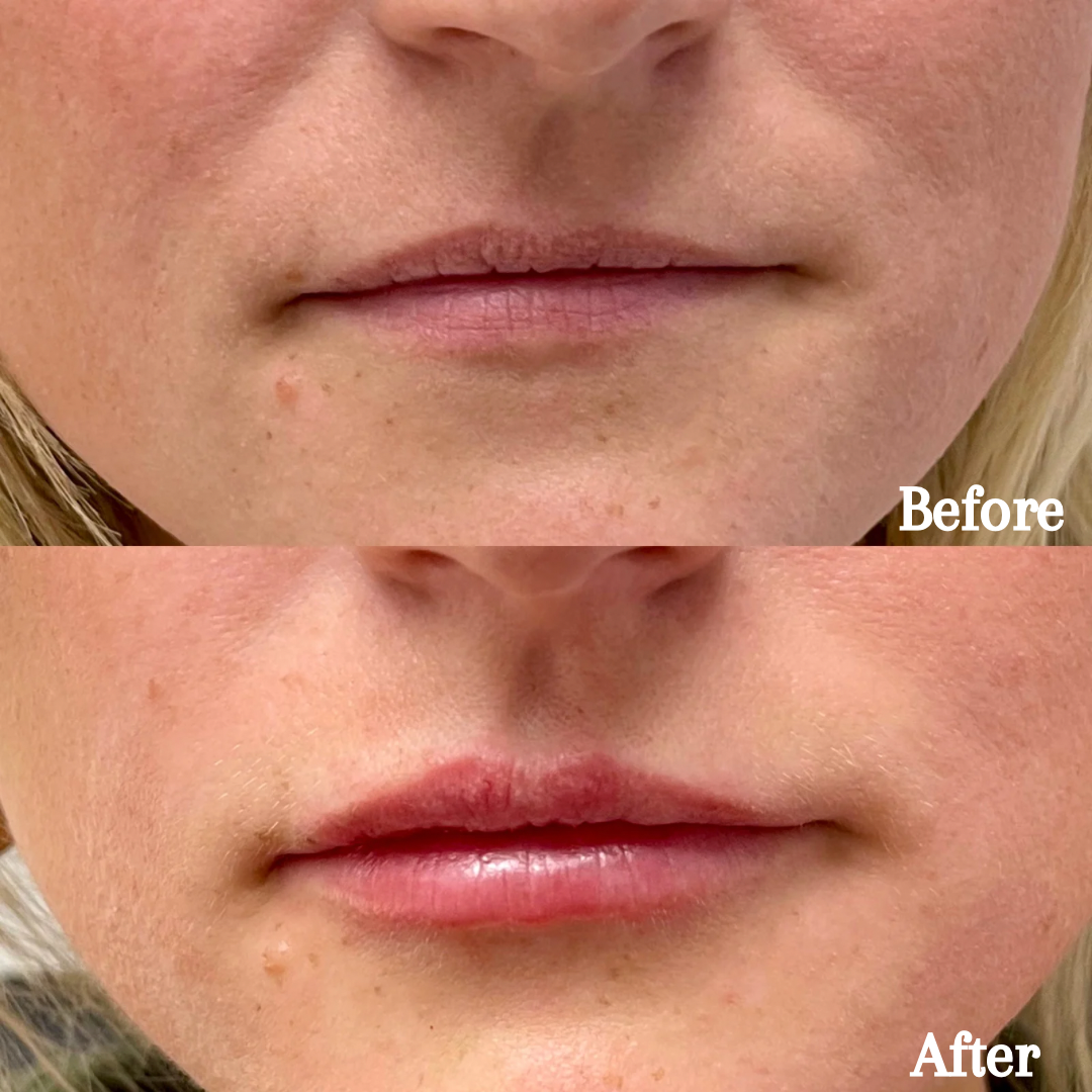 1 syringe of Revanesse Lips +
