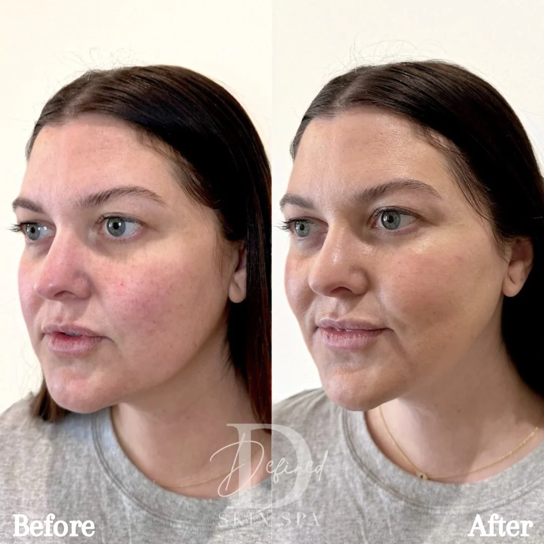 Full Facial Balancing