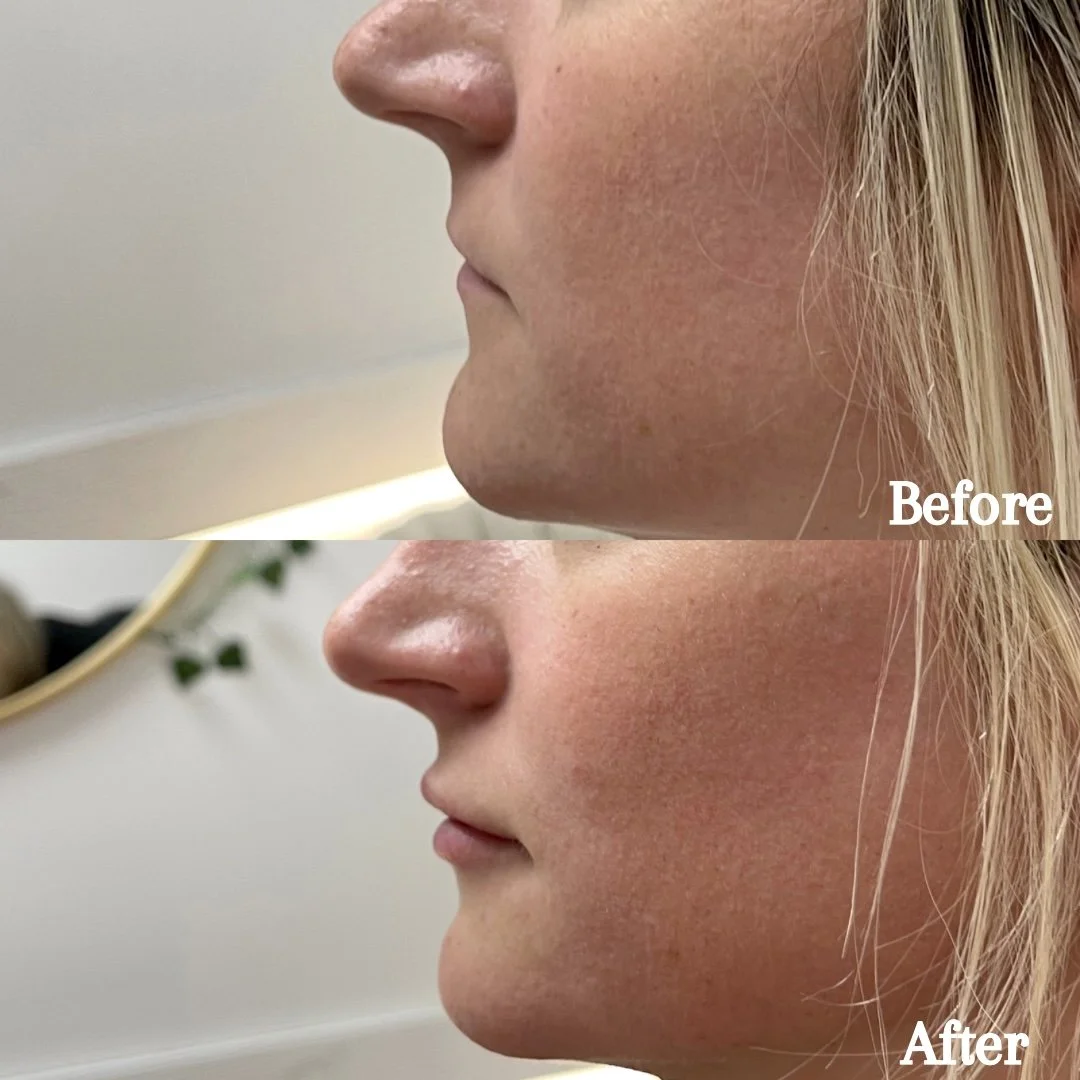 1 syringe of Revanesse Lips +