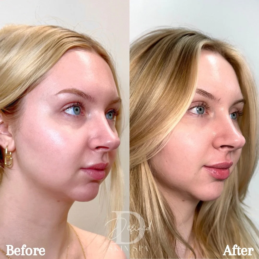 1 syringe of Lip Filler