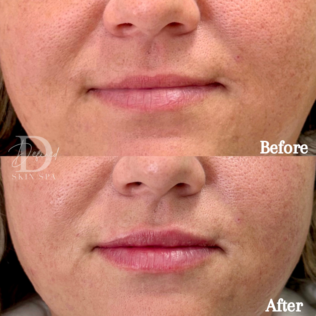 1.5 syringes of Revanesse Lips+