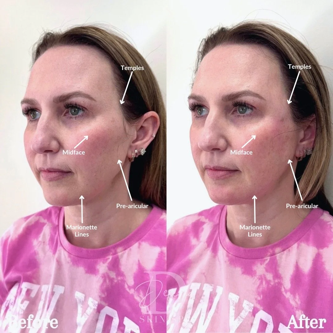 Full-Facial Balancing

(1 kit of Bellafill used)