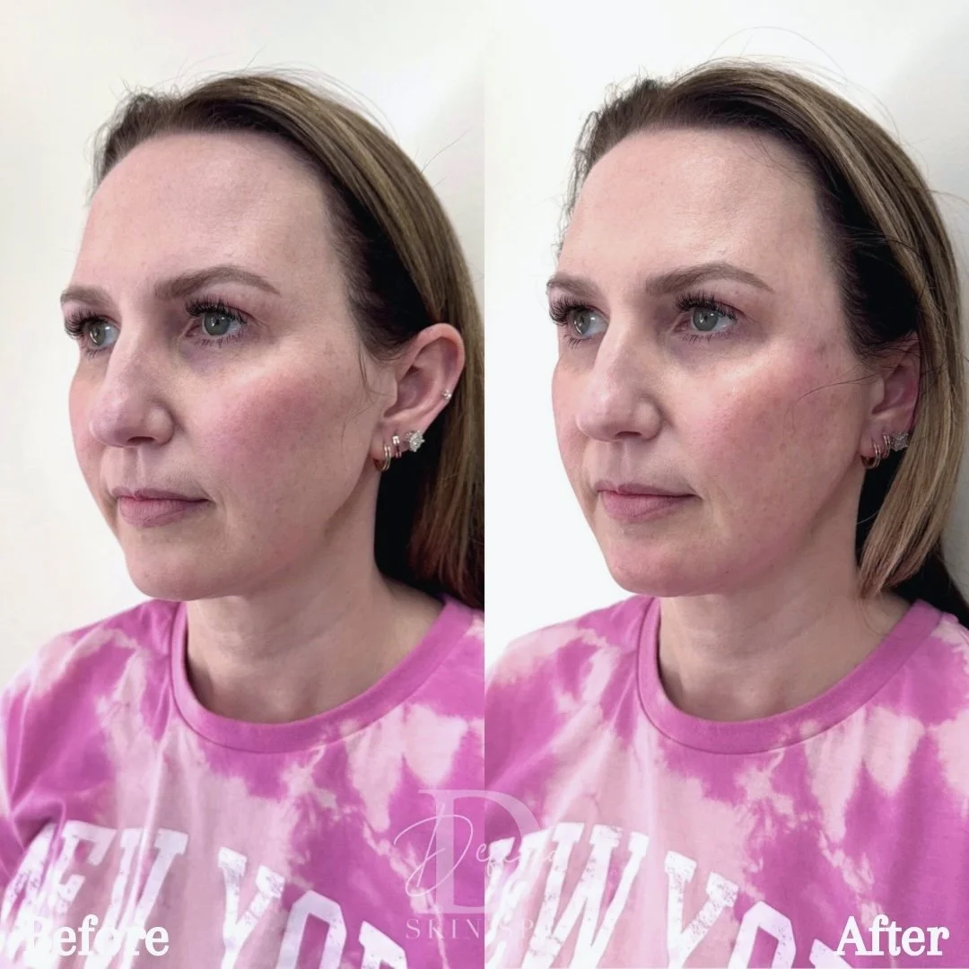 Full-Facial Balancing

(1 kit of Bellafill used)