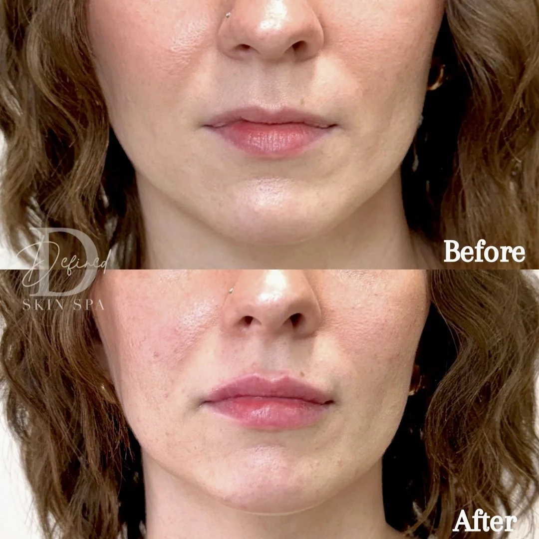 1.5 syringes of Revanesse Lips+