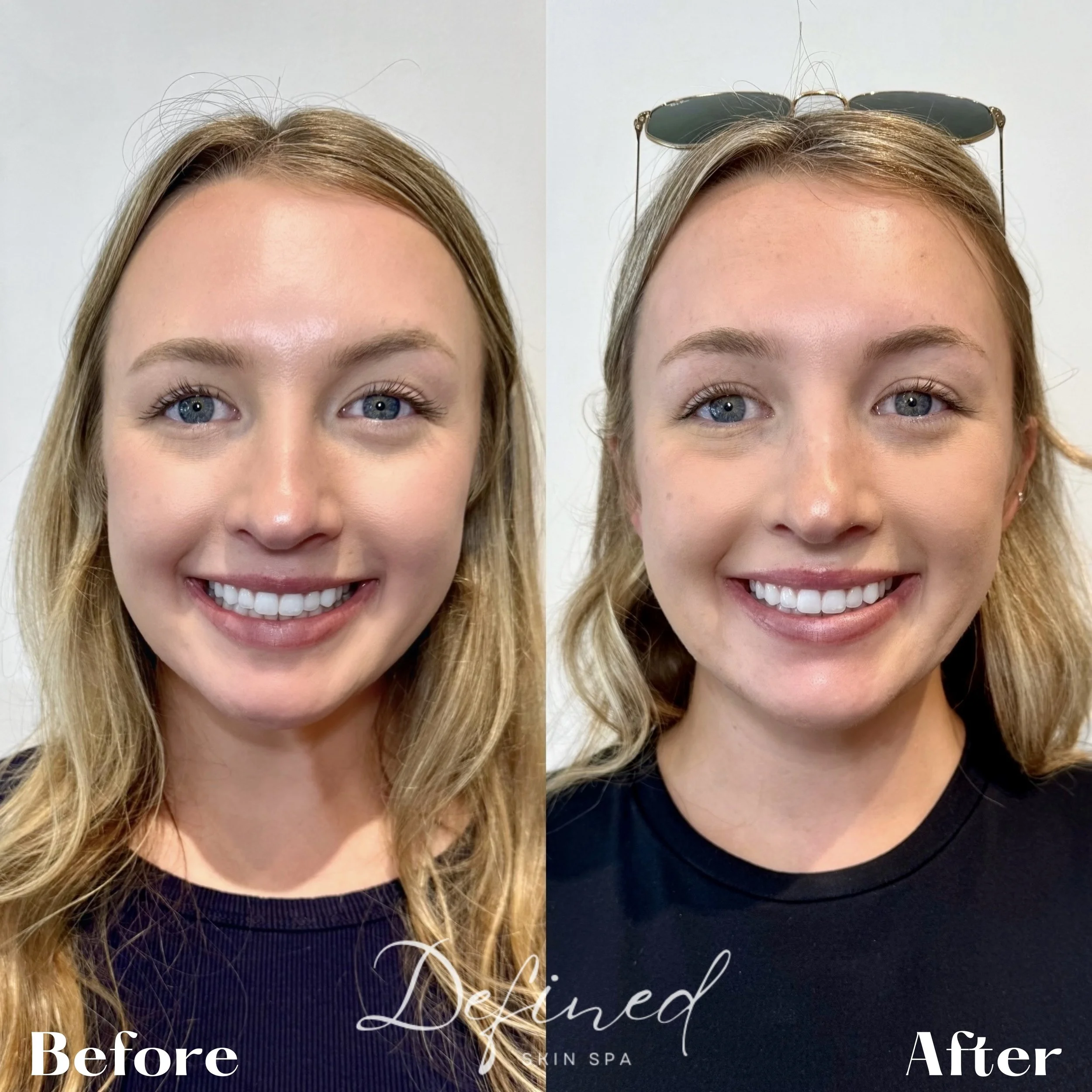 Brow symmetry correction & Lip Flip