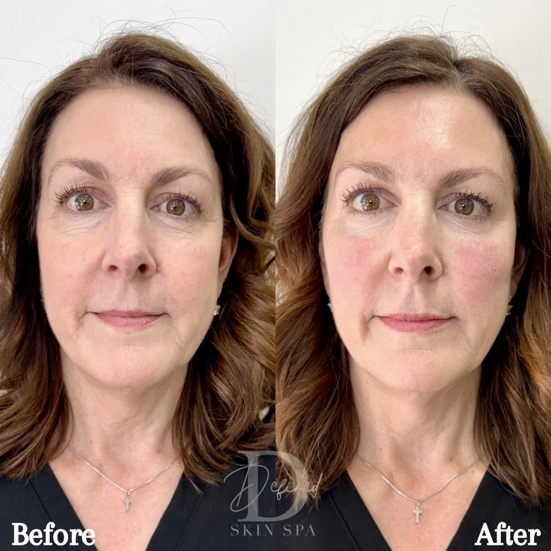 Full Facial Balancing - 

Filler:
Lips: 1 syringes of Revanesse Lips +
Midface: 3 syringes of Restylane Lyft & 1 syringe of Restylane Contour

Tox:
80 units of Jeuveau (Forehead, Glabella, Crow's Feet, Lip Flip, DAOs, Chin)
