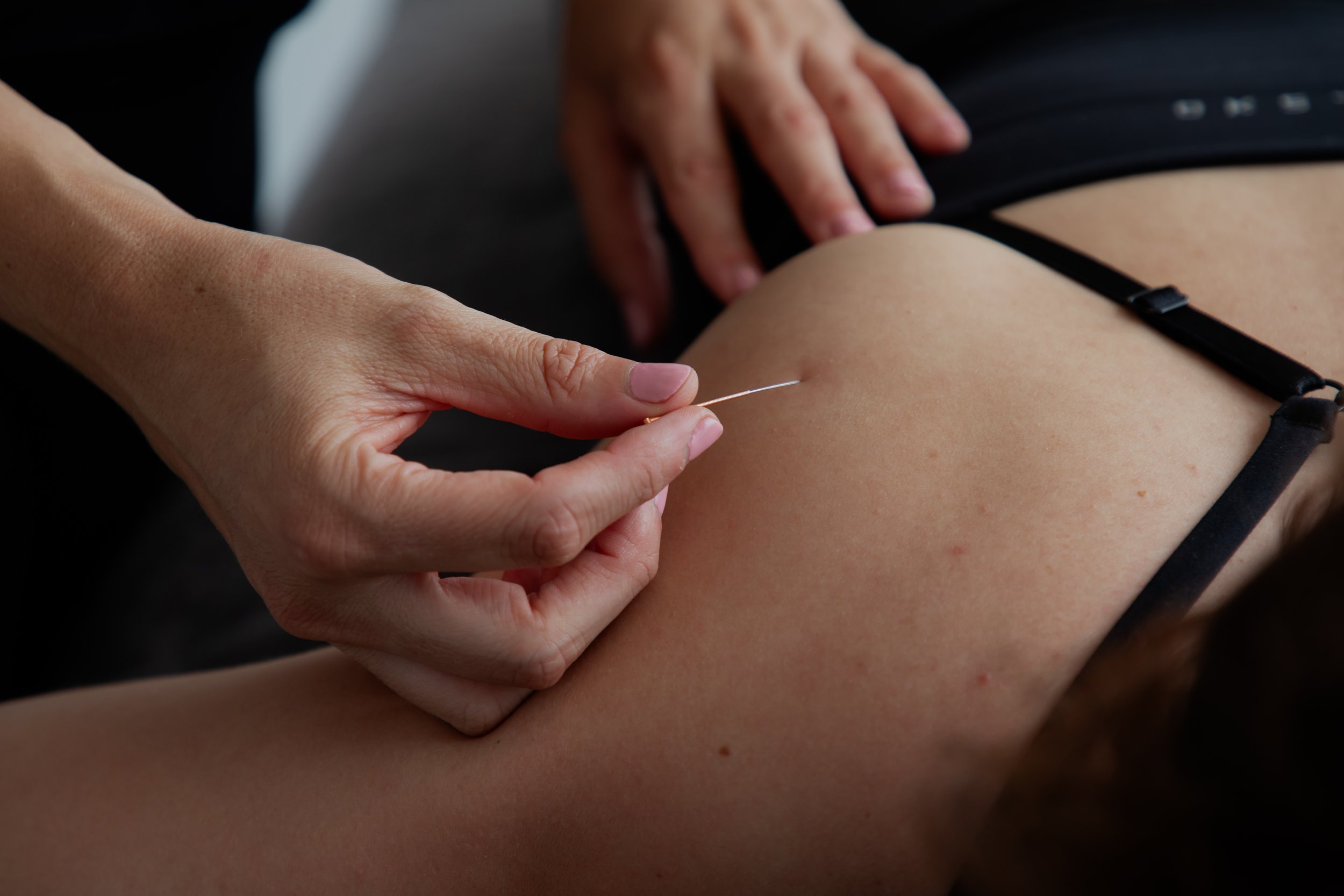 Dry Needling Gold Coast.jpg