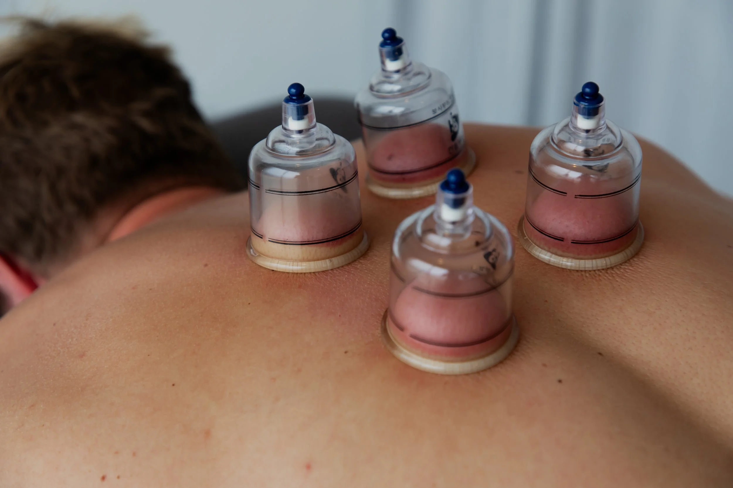 Cupping Release Gold Coast.jpg