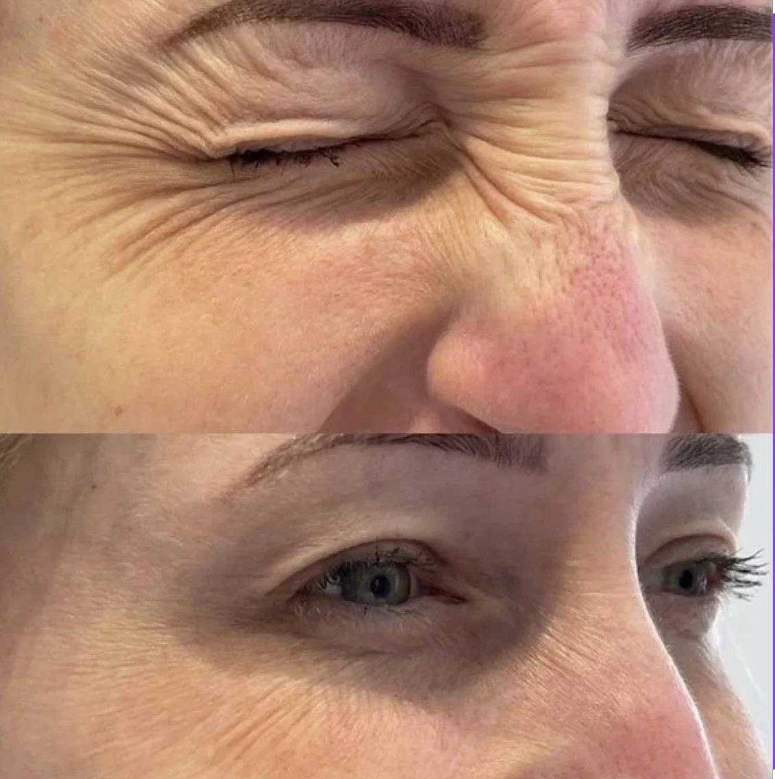 Close-up of two women's faces, one with closed eyes showing wrinkles and the other with open eyes showing smooth skin.