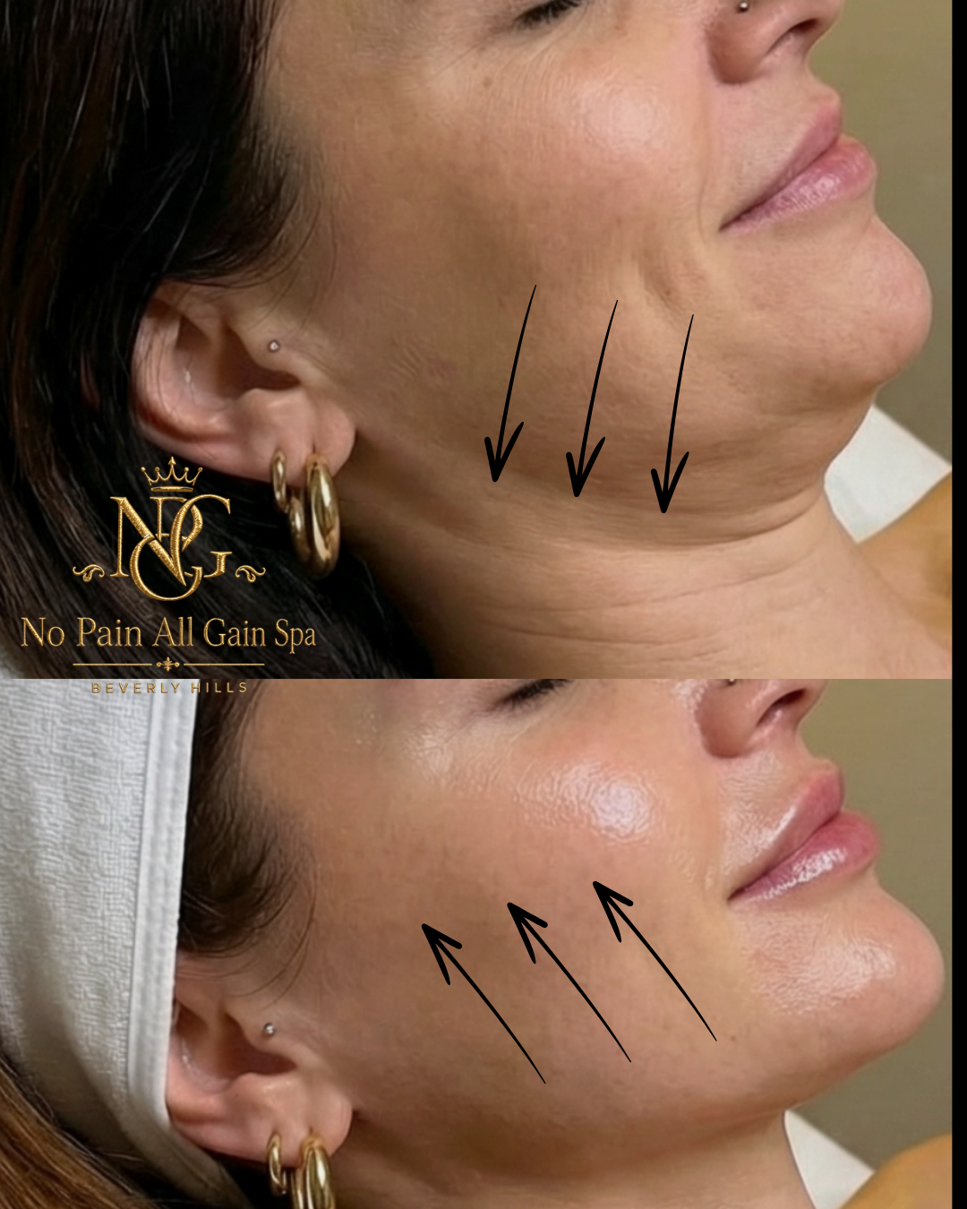 Before and after images of a woman's jawline showing a reduction in sagging and wrinkles, indicating a cosmetic or skincare treatment. The brand 'No Pain All Gain Spa' in Beverly Hills is displayed.