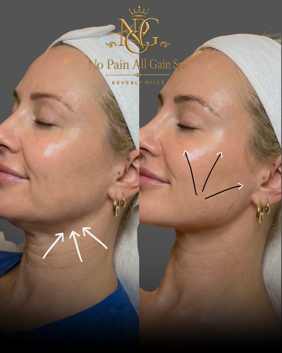 Side-by-side comparison of a woman's face and neck before and after a cosmetic treatment at No Pain All Gain Spa, Beverly Hills, showing improved skin smoothness and reduced lines, with arrows indicating areas of change.