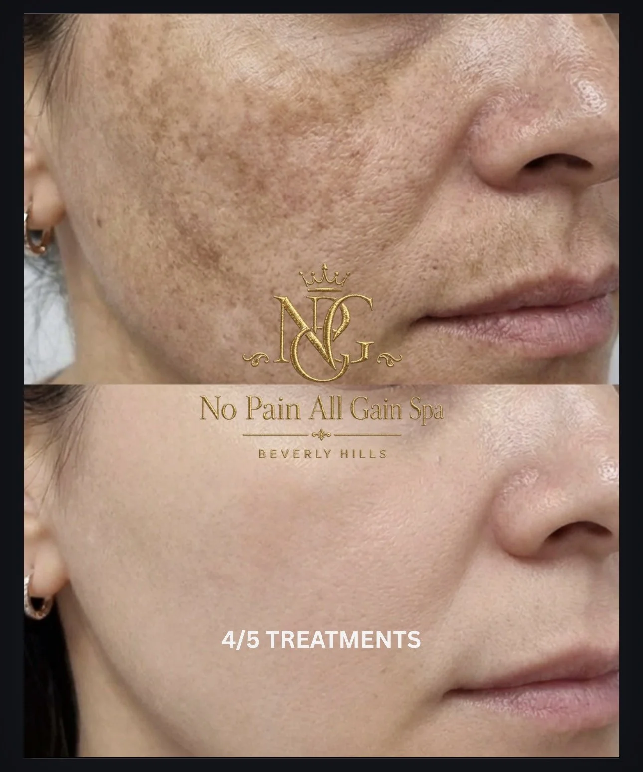 Before and after images showing the skin of a woman's face, with significant reduction in freckles and pigmentation after skincare treatments, promoting No Pain All Gain Spa in Beverly Hills.