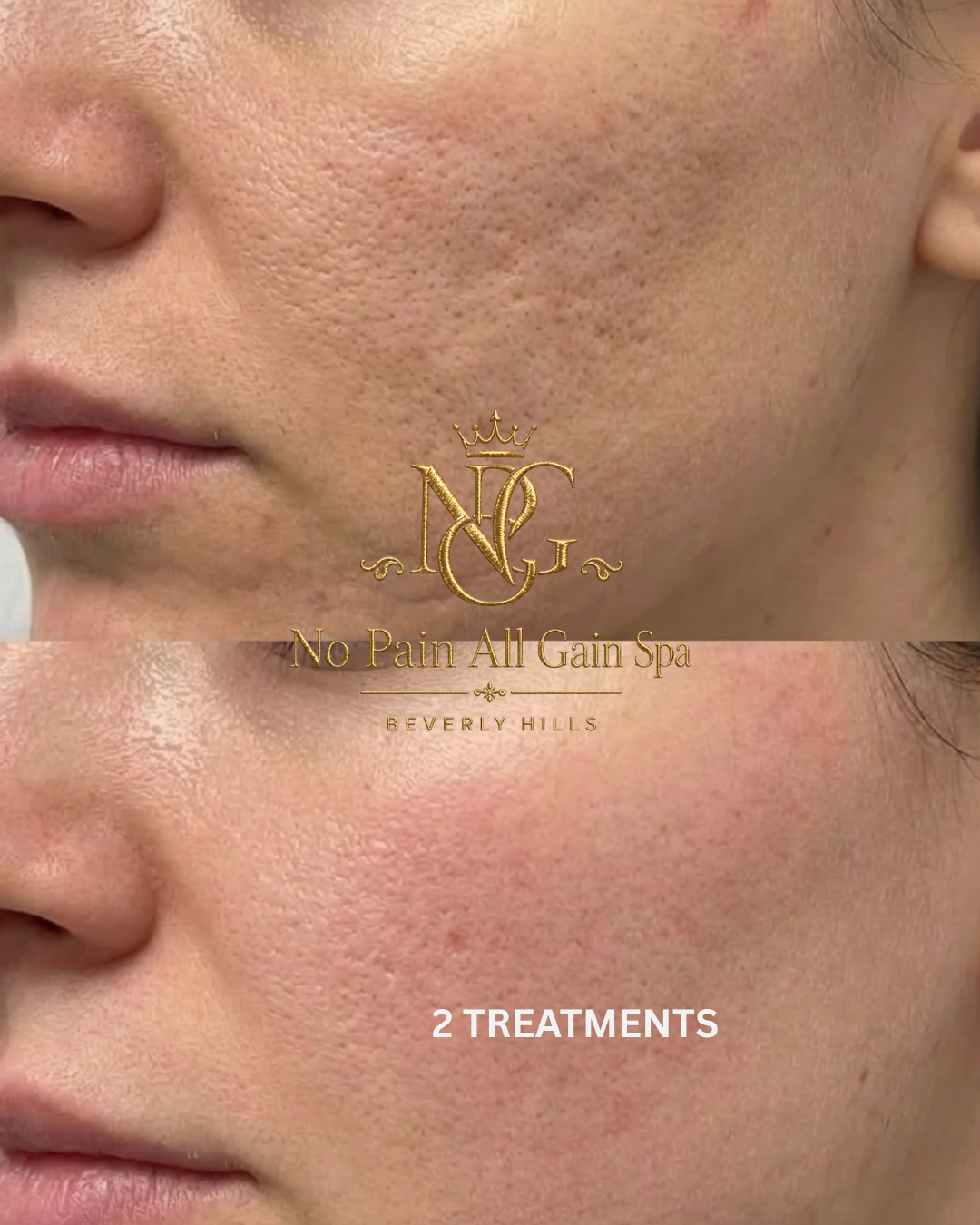 Close-up of a person's face showing improved skin texture after two treatments at No Pain All Gain Spa in Beverly Hills, with the spa's logo and name overlayed.
