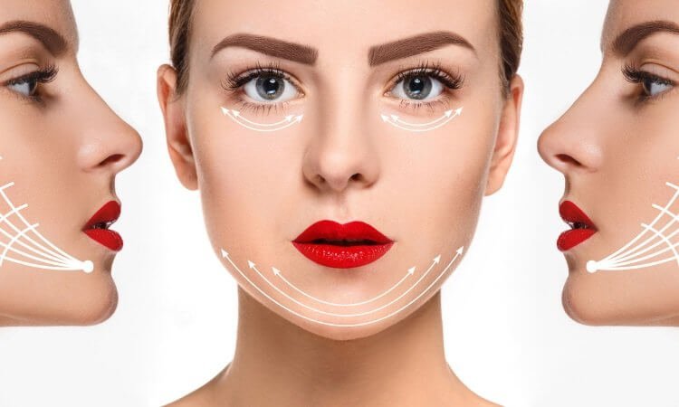 Before and after images of a patient who received PDO thread lift at No Pain All Gain Spa in Beverly Hills.