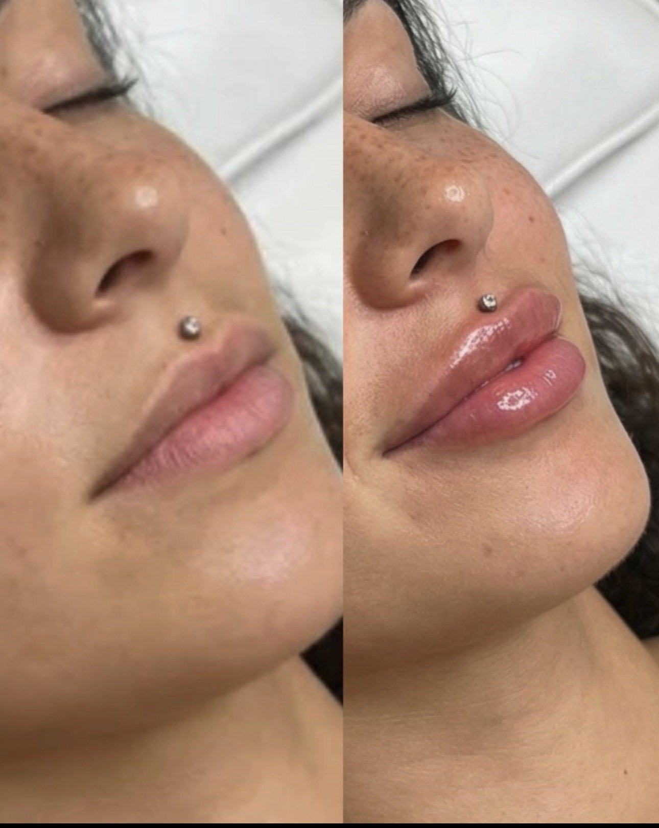 Comparison of a woman's face before and after lip filler treatment, showing fuller, glossy lips in the after image.