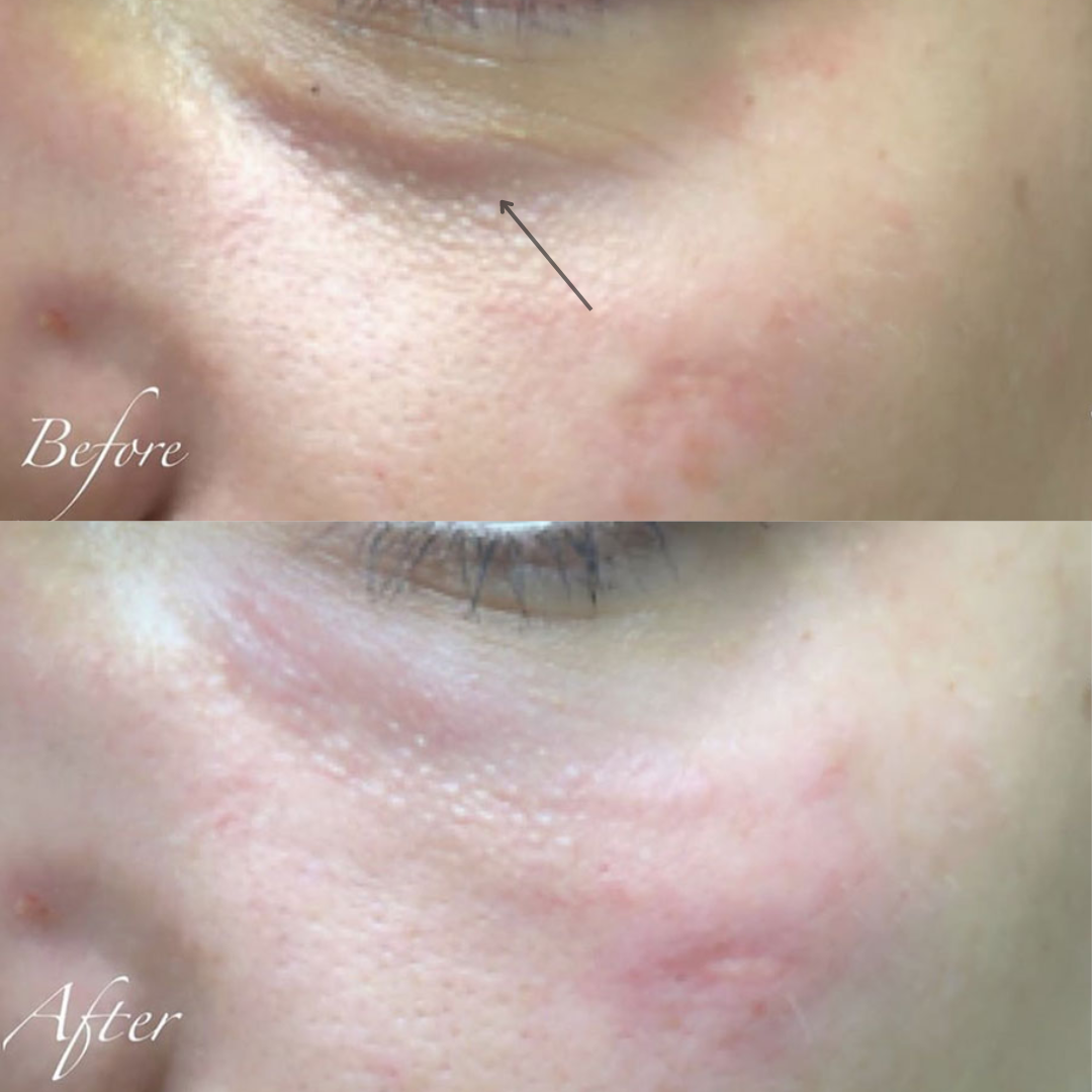 Close-up of skin around the eye showing before and after skin improvements, with visible reduction in redness and pores.